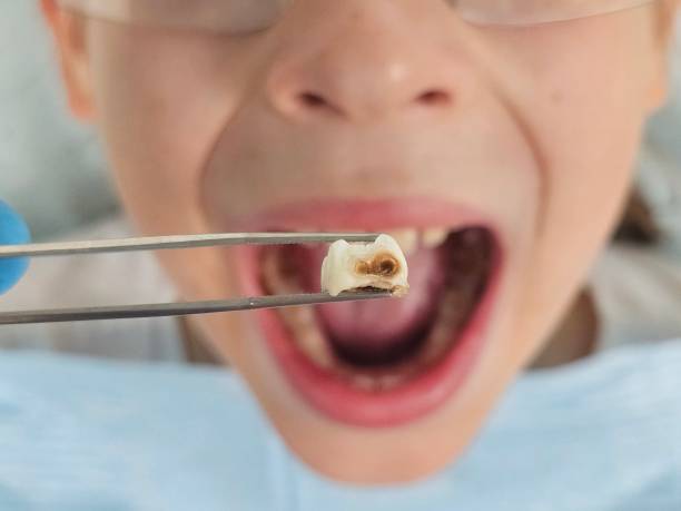 Best Emergency Treatment for Oral Infections in Kings Park West, VA