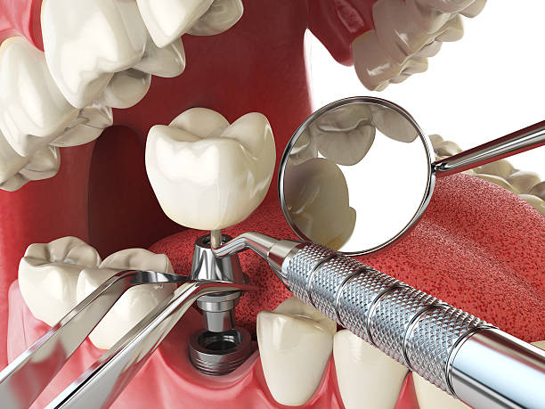 Best Knocked-Out Tooth (Avulsed Tooth) Treatment in Kings Park West, VA